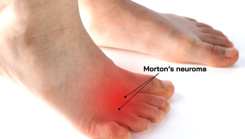 Mortons Neuroma Understanding Causes Symptoms And Treatment Mr Mike Barrett